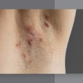 Can Laser Hair Removal Cause Infection? - An Expert's Perspective